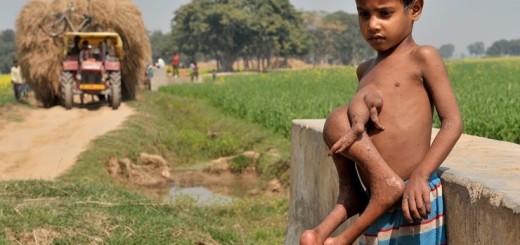 Близнец-паразит