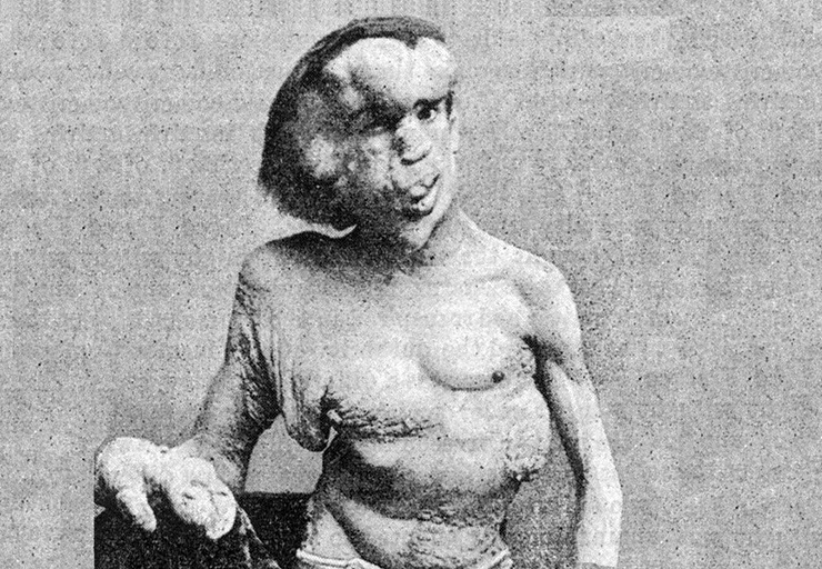 Джозеф Кэри Меррик