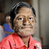 Гипертрихоз