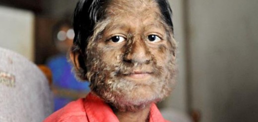 Гипертрихоз