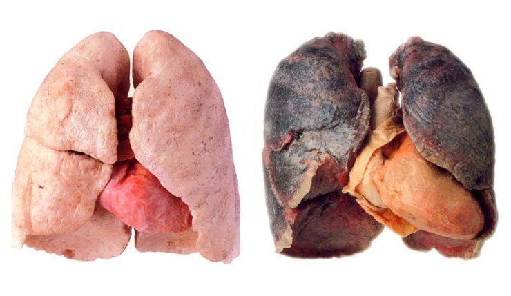 лёгкие после курения